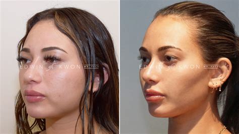 buccal fat removal norge|Buccalfett fjerning .